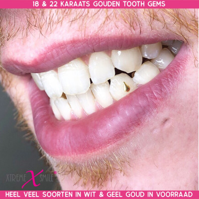 Zahnschmuck Weißgold Tropfen – Teardrop Tooth Gem