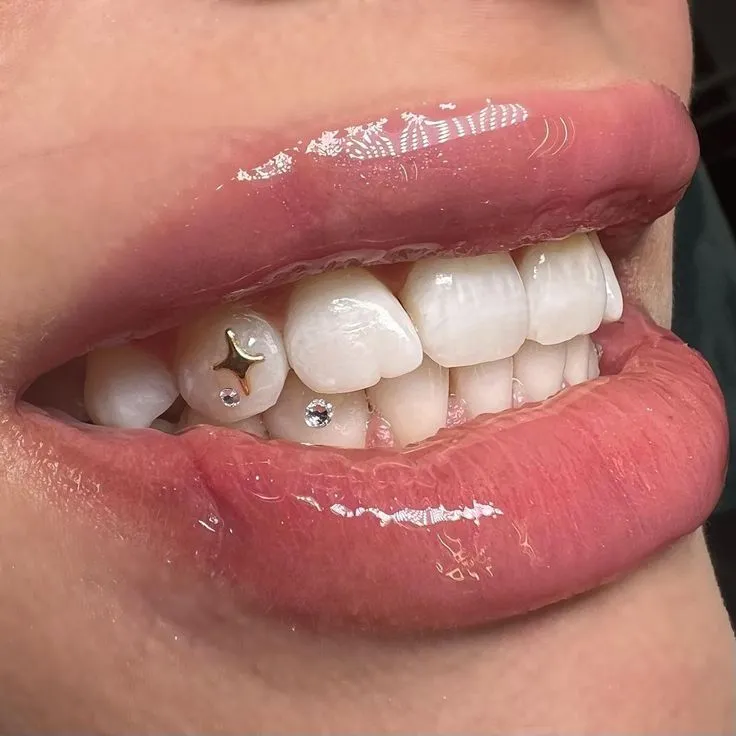 Gouden tooth gem gecombineerd met kristallen als voorbeeld van design mapping