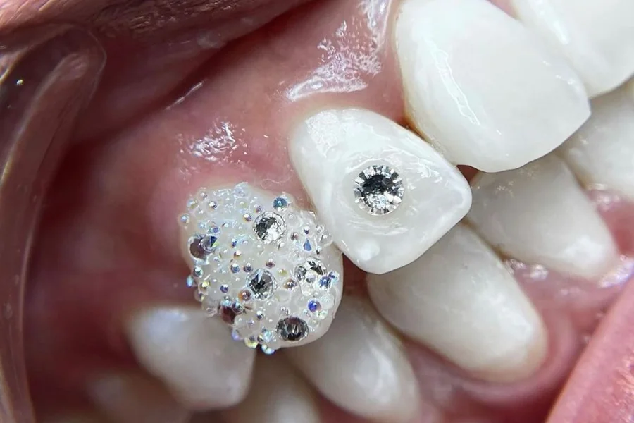 Professionele cursus tooth gems en tandkristallen